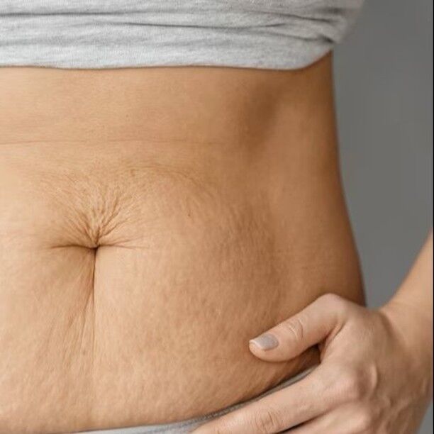 Stretch Mark Solutions: Banishing Those Battle Scars

We understand that these marks could have a big impact on how you feel about yourself and how you see yourself. By providing you with effective treatments that may reduce the visibility of stretch marks and help you regain your confidence, we are here to assist.

 

Stretch marks are quite common and can occur for various reasons, such as rapid weight gain or loss, pregnancy, puberty, or even due to genetic factors. They form when the deeper layers of your skin stretch, resulting in those visible lines or streaks on the surface.

In this article, we’ll look at the issues that result in stretch marks. Knowing their anatomy and physical characteristics can help you better comprehend their causes and consequences on your skin.

But relax, not everything is lost. We’ll also go through ways to stop stretch marks from developing in the first place. Adopting basic lifestyle habits like eating healthfully, getting enough water, and exercising often will significantly improve the suppleness of your skin.

If you already have stretch marks, fear not! We’ll guide you through a variety of home remedies and natural treatments that have shown promise in reducing their appearance. You’ll learn about the effectiveness of topical treatments including creams, lotions, and oils as well as the advantages of mild exfoliation and massage methods.

We’ll analyse the medical services provided by dermatologists. Prescription lotions, laser therapy, microdermabrasion, and chemical peels can all help you enhance the look of your skin and lessen the visibility of stretch marks.

It’s important to remember that stretch marks won’t entirely go away. We intend to help you feel more at ease in your own skin by offering you procedures that might considerably improve your looks, raise your self-esteem, and make you feel better about yourself.

Then come on over. Join this journey as we explore effective stretch mark solutions and empower you to embrace your body. Let’s banish those battle scars and reveal a more confident, beautiful you!

Know more about this recipe please follow the link in bio

#skincare #skin #stretchmarks #pregnancy